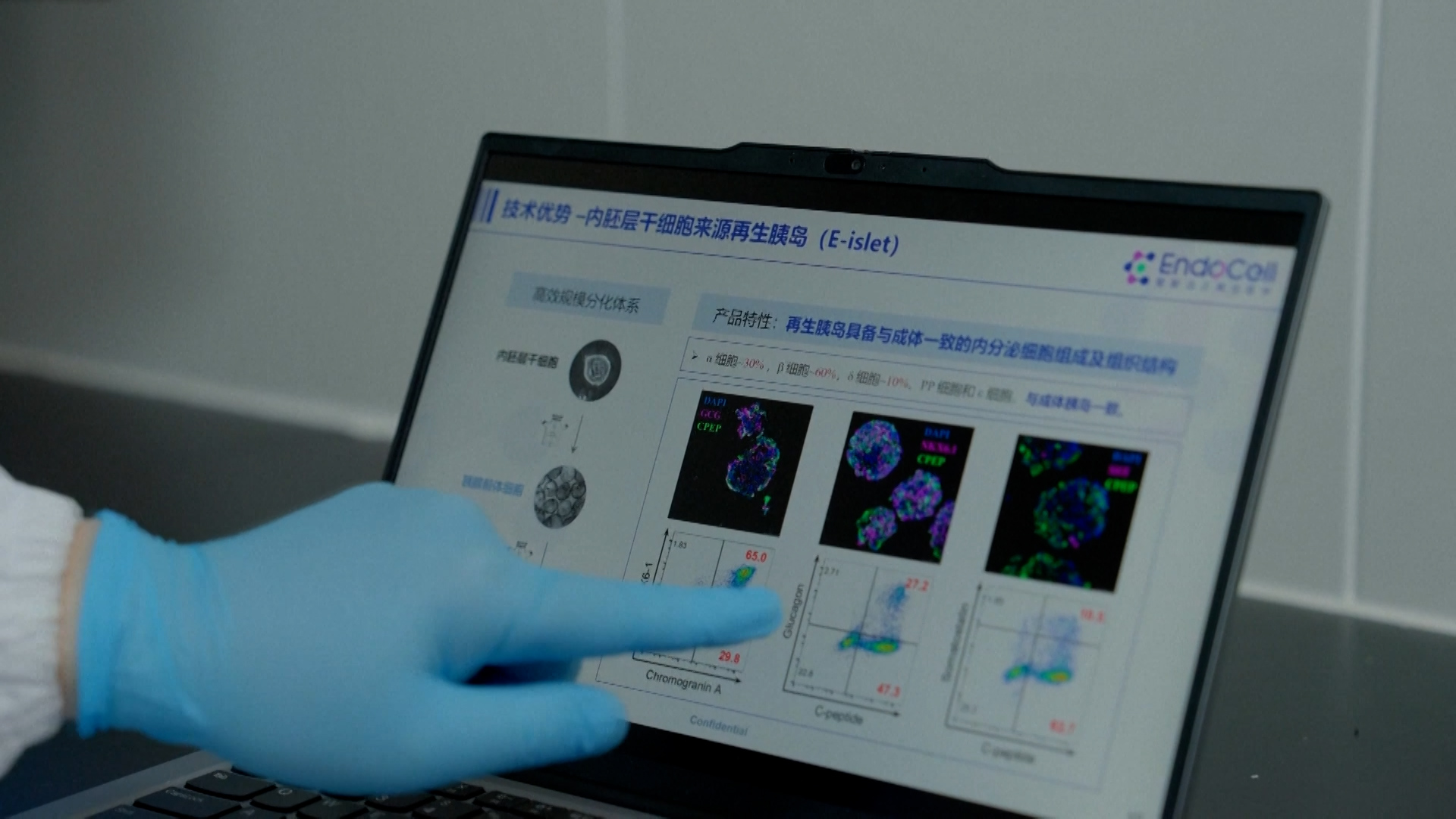 Chinese scientists transplant stem cell-derived islets to treat type 1 diabetes