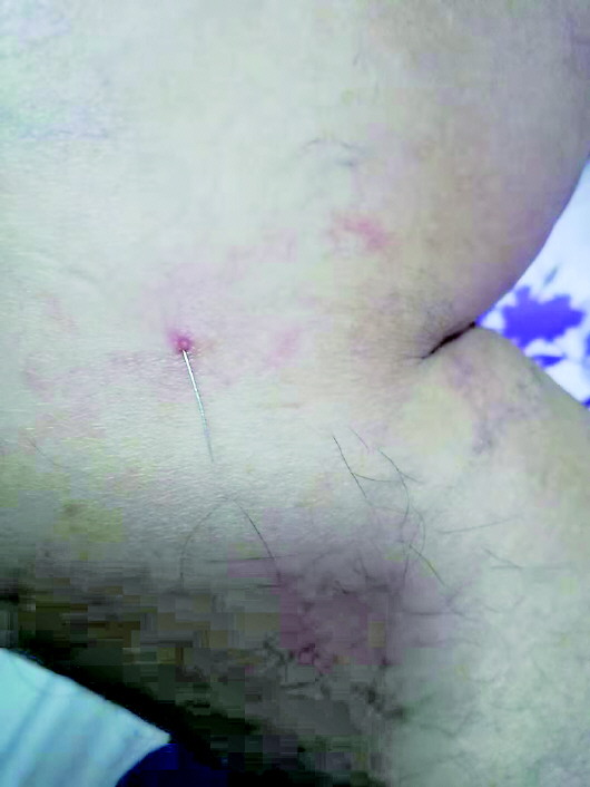 手术导丝断在体内近两年 患者向医院索赔600万